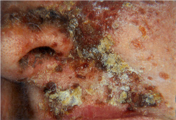 microorganismos zonadental4